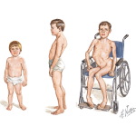 Muscular Dystrophies