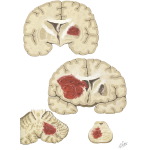 Hypertensive Apoplexy