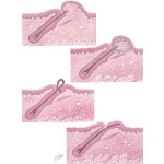 Shaving: A Cause of Skin Disorders