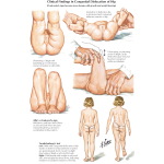 Clinical Findings in CDH