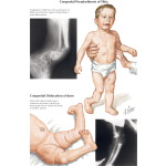 Congenital Pseudarthrosis of Tibia