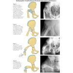 Illustration of Radiographic Classification of Proximal Femoral Focal Deficiency from the Netter Collection