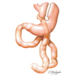 Gastric Bypass (Roux-en-Y)