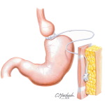 Laparoscopic Adjustable Gastric Banding