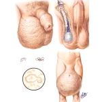 Elephantiasis of the Scrotum