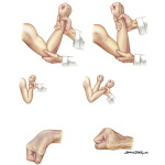 Hysterical Conversion Reactions - Test for Extensor Weakness In Upper Extremity