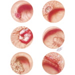 Gastroscopic Diagnosis of Malignant Disease