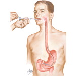 Gastroscopic Diagnosis of Malignant Disease
