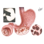 Gastric Ulcer