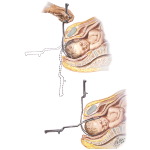 Application of Forceps (Left and Right Blade)