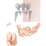 Signs of Hip Dislocation