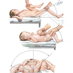 Iliopsoatic Reinforced Tension Signs I