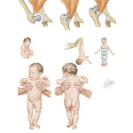 Iliopsoas Syndromes