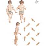 Iliopsoas Syndromes