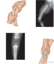 Child Abuse: Skeletal Injury