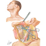 Radical Neck Dissection