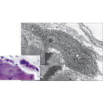 Light Micrograph of Bone Showing Two Osteoclasts With Electron Micrograph of an Osteoclast In the Process of Resorbing Bone