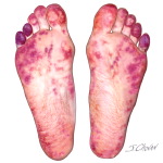 Purple Toe Syndrome Associated With Vitamin K Antagonist Therapy