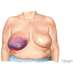 Vitamin K Antagonist-Induced Skin Necrosis