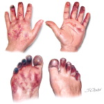 Digital Ischemia In a Patient With Heparin-induced Thrombocytopenia (HIT)