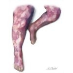 Clinical Presentation of Disseminated Intravascular Coagulation