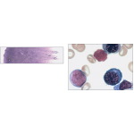 Light Micrograph of a Bone Marrow Smear at Low (Above) and High (Right) Magnifications