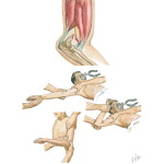 Supracondylar Fracture