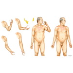 Truncal Obesity