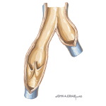Venous Thrombosis