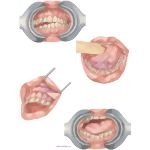Facial Trauma: Purple Gums