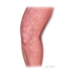 Livedo Reticularis