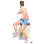 Classic TRAPS Rash That Migrates In a Centrifugal Pattern