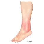 Typical Appearance of Erysipelas-like FMF Rash Often On Lower Extremities