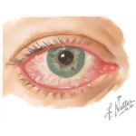 Conjunctivitis