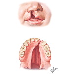 Cleft Lip and Palate