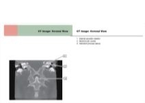 CT Image: Coronal View