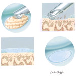 Surgical Procedures for Preservation of Articular Surface