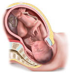 Shoulder Dystocia