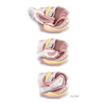 Uterine Prolapse