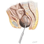 Forceps Aided Delivery