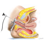 Hysteroscopy