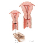 Intrauterine Contraceptive Device (IUCD) Insertion