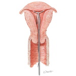 Intrauterine Contraceptive Device (IUCD) Removal