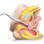 Transvaginal Ultrasonography