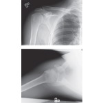 Radiographic Anatomy: Shoulder