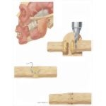 Facial Trauma: Repair of Facial Nerve