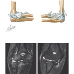 Ligaments of the Elbow