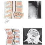Vertebral Bodies
