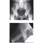 Radiographic Anatomy of the Pelvis and Hip