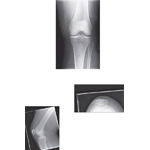 Radiographic Anatomy of the Knee
